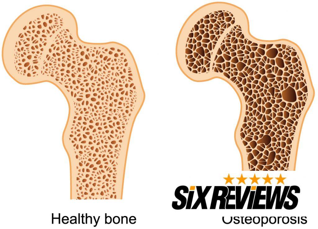 osteoporosis