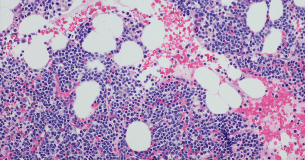 Myeloma
