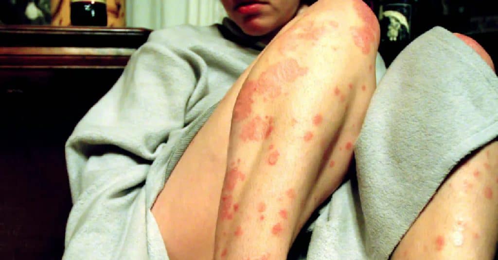 Psoriasis Example