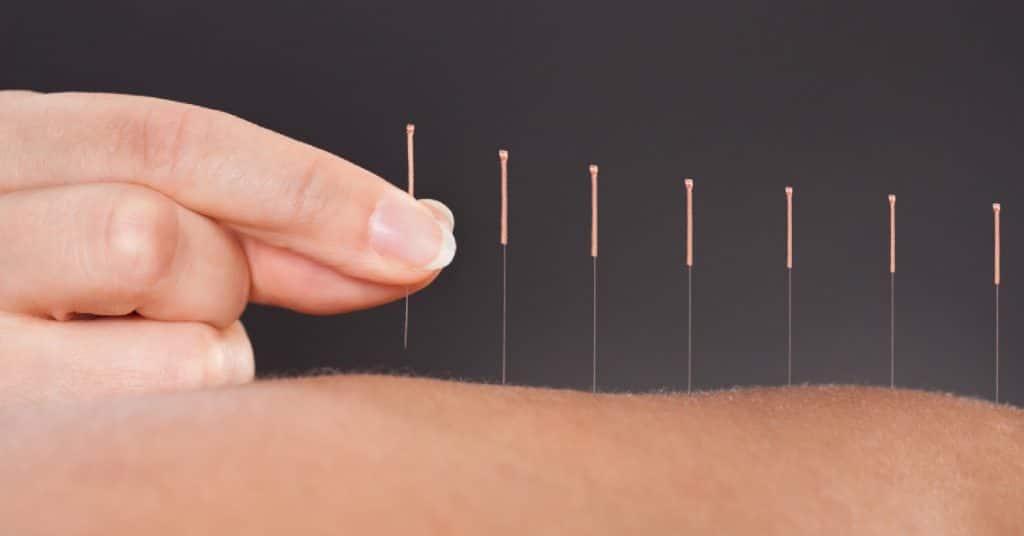 Acupuncture